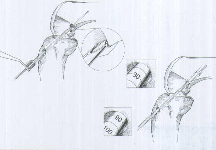 肌腱韌帶固定系統注冊技術審查指導原則（2020年第36號）